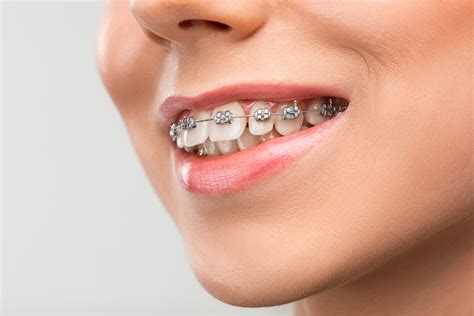 de que material estan hechos los brackets metalicos|que es un bracket.